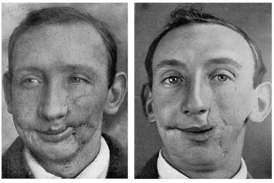 Photographs documenting the facial reconstruction of a soldier whose cheek was extensively wounded during the Battle of the Somme